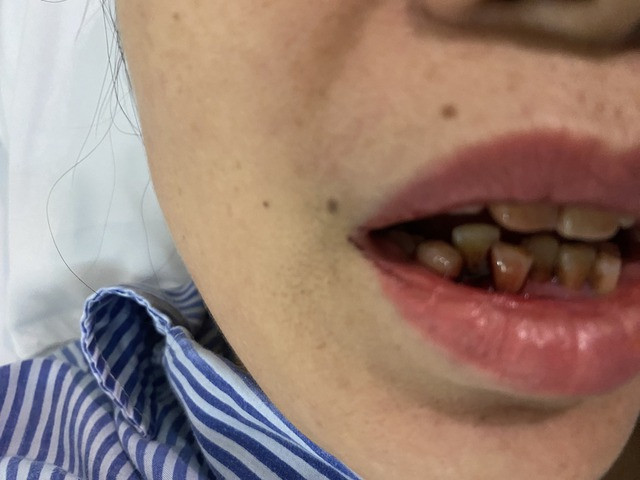 Cảnh báo: Người bệnh đái tháo đường mắc sốt xuất huyết dễ có nguy cơ biến chứng nặng - Ảnh 1.