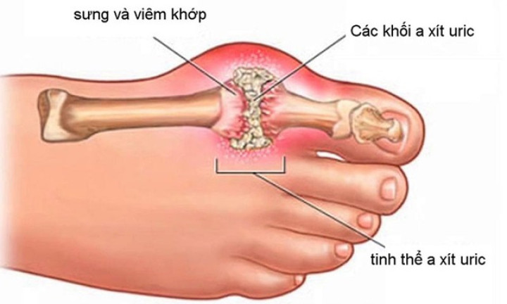 6 biến chứng nguy hiểm thường gặp ở bệnh gout